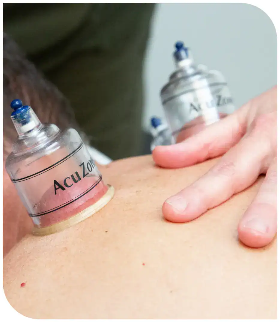 cupping benefit